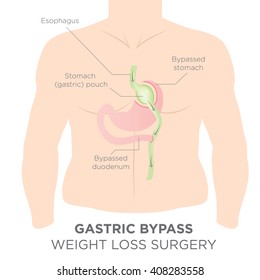 Gastric Bypass For Weight Loss - You Are Actually Re-routing Your Stomach In Order To Feel Full And Eat Less