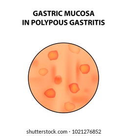 Gastric mucosa in polypous gastritis. Infographics. Vector illustration on isolated background