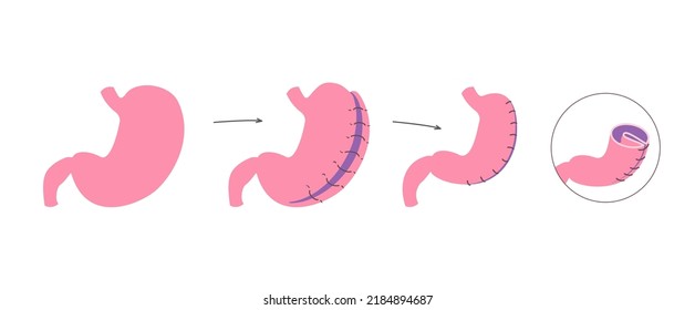 Gastric Plication Flat Infographics. The Explanation Picture Of Stomach Reduce Method Via Laparoscopic Operation