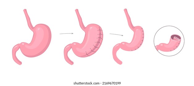 Gastric Plication Infographics. The Explanation Picture Of Stomach Reduce Method Via Laparoscopic Operation