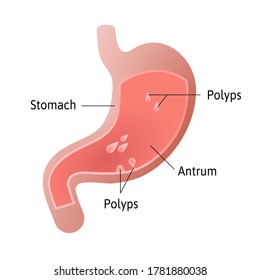 gastric polyps, masses of cells that form on the lining inside stomach. pedunculated and flat-based polyp. Antrum. Medical vector illustration marked with lines.