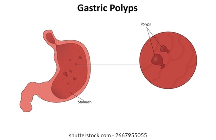 Pólipos gástricos en la Ilustración vectorial estomacal