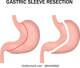 Gastric sleeve resection infographic. Stomach reduction surgery for weight loss. Medicine concept. Vector illustration.