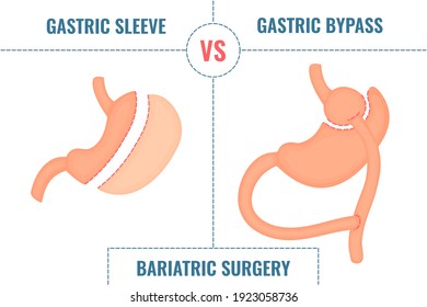 Gastric sleeve vs gastric bypass. Bariatric surgery weight loss procedures comparison. Stomach reduction anatomical diagram infographics. Health care  medical concept. Vector illustration.