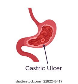 Gastric ulcer stomach disease flat vector illustration