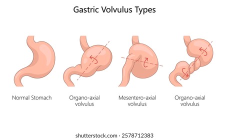 gastric volvulus types, normal stomach, organo-axial volvulus, mesentero-axial volvulus with rotational axes diagram hand drawn schematic vector illustration. Medical science educational illustration