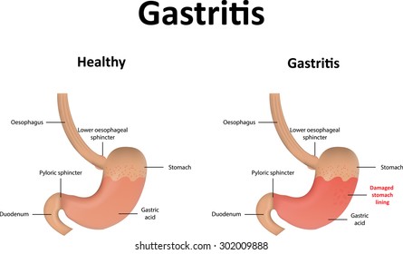 Gastritis