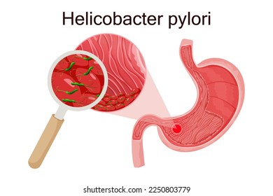 Gastritis caused by helicobacter pylori in stomach under magnifying glass. Detailed vector illustration, cartoon style, white background
