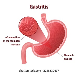 Gastritis detalla la inflamación de la mucosa. Infografía, ilustración vectorial, estilo de dibujos animados, fondo blanco
