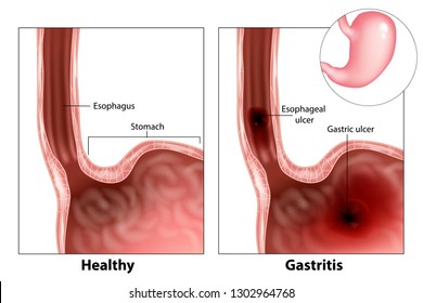 Gastritis (Esophageal ulcer,
Gastric ulcer). Illustration of stomach