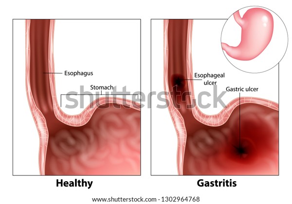 Gastritis Esophageal Ulcer Gastric Ulcer Illustration Stock Vector Royalty Free 1302964768 