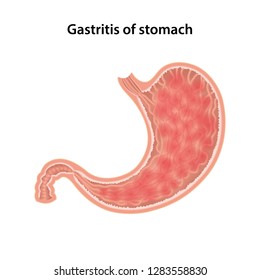 Gastritis Stomach Anatomical Vector Illustration Gastritis Stock Vector ...