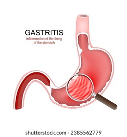 Gastritis. Stomach Inflammation. Gastrointestinal Disorders. Cross section of a human stomach and inflammation of the lining of the stomach under Magnifying glass. Vector illustration