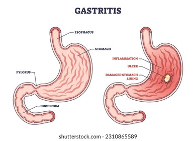 Gastritis as stomach lining inflammation illness and disease outline diagram. Labeled educational gastric problem with burning and pain in intestinal tract vector illustration. Medical structure.