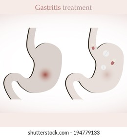Gastritis treatment illustration with stomach sign and tablets in it poster for hospital