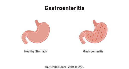 Diseño científico de la enfermedad gastroenteritis. Ilustración vectorial.	