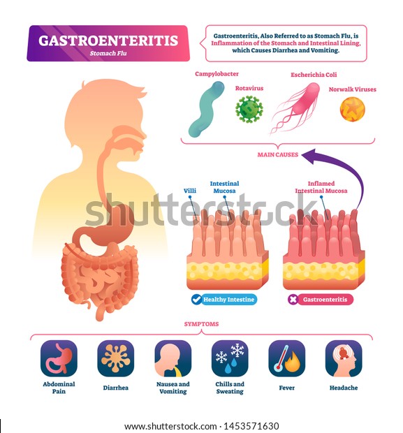 Gastroenteritis vector illustration. Labeled\
stomach inflammation scheme. Flu causes, symptoms and compared\
healthy closeup intestinal mucosas and infected diagram. Anatomical\
digestive pain\
problems.