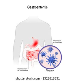 Viral Gastroenteritis Images Stock Photos Vectors Shutterstock