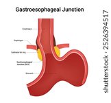 Gastroesophageal Junction (GEJ) an Overview