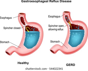 Gastroesophageal Reflux Disease