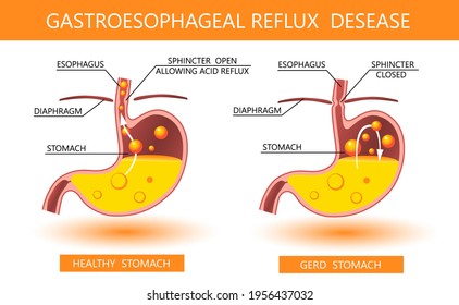 Gastroesophageal reflux disease 3d. Acid reflux, heartburn and gerd infographic with medical vector illustration. Healthy and sick stomach. Medicine anatomy healthy organ and illness. GERD infographic