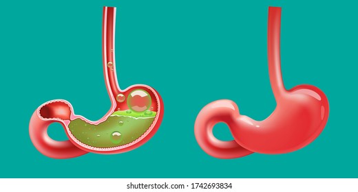 Gastroesophageal Reflux Disease, Acidity, Upset, Pain. Healthy Food Nutrition, Stomach Concept. Vector Illustration Isolated On Green Background.