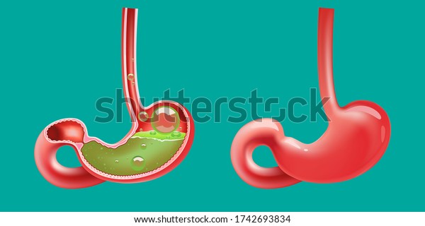 Gastroesophageal Reflux Disease Acidity Upset Pain Stock Vector ...