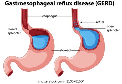 Open Esophagus High Res Stock Images Shutterstock