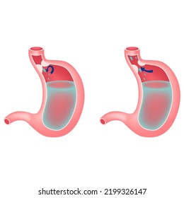 Gastroesophageal Reflux Disease Chronic Pathology That Stock Vector ...