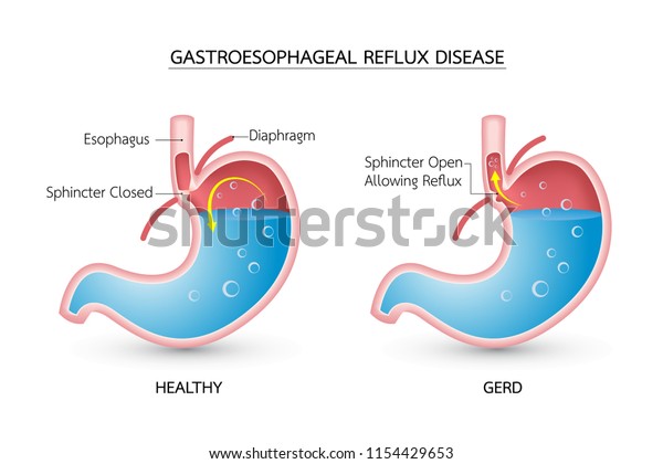 Gastroesophageal Reflux Disease Gerd Acid Reflux Stock Vector (royalty 