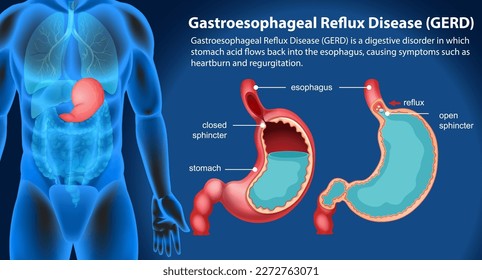 Gastresophageale Refluxkrankheit (GERD) Abbildung