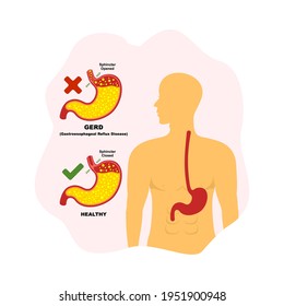 
Gastroesophageal reflux disease (GERD), illustration of the health condition of the human stomach.