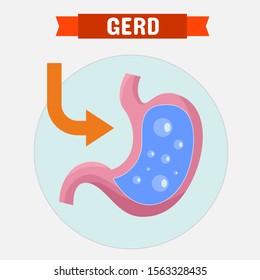 Gastroesophageal Reflux Disease (GERD) Infographic Template Design. GERD Symptoms And Prevention.