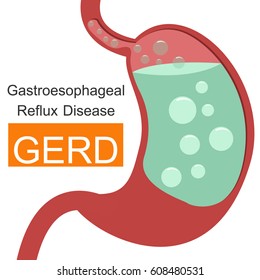 Gastroesophageal Reflux Disease (GERD) Infographic.