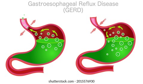 
Gastroesophageal Reflux Disease GERD. Stomach anatomy structure. Digestive system organ section diagram. Red body, green liquid gas bubbles. Gastric illness. Medical draw graphic. Illustration vector