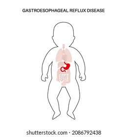 Enfermedad de reflujo gastroesofágico en silueta infantil. Trastorno digestivo y problema de ERG en el cuerpo del bebé humano. Dolor, ardor de estómago en el pecho infantil, estómago y esófago, ilustración vectorial de reflujo ácido