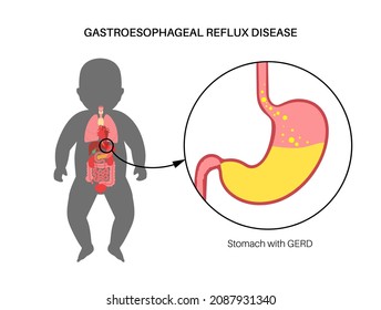 Gastroesophageal Reflux Disease In Infant Silhouette. Digestive Disorder And GERD Problem In Human Baby Body. Pain, Heartburn In Child Chest, Stomach And Esophagus, Acid Reflux Vector Illustration