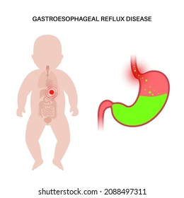 Gastroesophageal reflux disease in infant silhouette. Digestive disorder and GERD problem in human baby body. Pain, heartburn in child chest, stomach and esophagus, acid reflux vector illustration