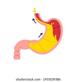 Gastroesophageal reflux disease isolated vector illustration. Esophagus medical symptom, design element. Stomach healthcare icon.
