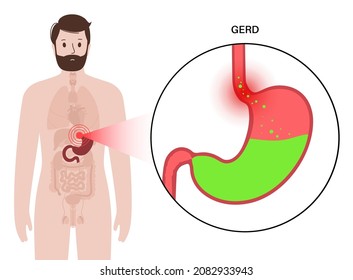 Gastroesophageal Reflux Disease Poster. Digestive Disorder And GERD Problem In Human Body. Pain, Heartburn In Chest, Stomach And Esophagus. Open Sphincter Allows Acid Reflux Flat Vector Illustration..