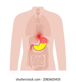 Gastroesophageal reflux disease poster. Digestive disorder and GERD problem in human body. Pain, heartburn in chest, stomach and esophagus. Open sphincter allows acid reflux flat vector illustration..