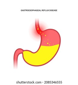 Gastroesophageal reflux disease poster. Digestive disorder and GERD problem in human body. Pain, heartburn in chest, stomach and esophagus. Open sphincter allows acid reflux flat vector illustration..