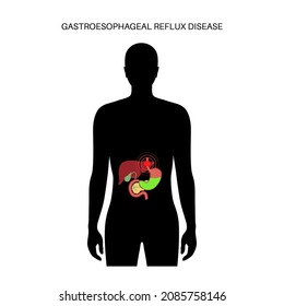 Gastroesophageal reflux disease poster. Digestive disorder and GERD problem in human body. Pain, heartburn in chest, stomach and esophagus. Open sphincter allows acid reflux flat vector illustration..