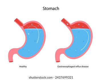 Gastroesophageal reflux disease stomach. GERD, heartburn. Normal internal organ and stomach with Acid reflux. 