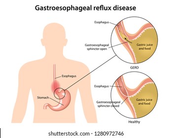 Gastroesophageal reflux disease stomach with main parts labeled. Medical vector illustration with the shape of sick human body, fragments of healthy and sick stomach isolated on white background