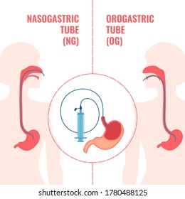 Gastrointestinal System Infographics. Nasogastric And Orogastic Tubes Passed Through Nose And Mouth To Stomach. NG And OG Enteral Feeding Tubes. Emergency Medical Concept. Vector Illustration.
