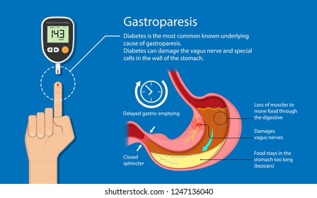stomach gastroparesis