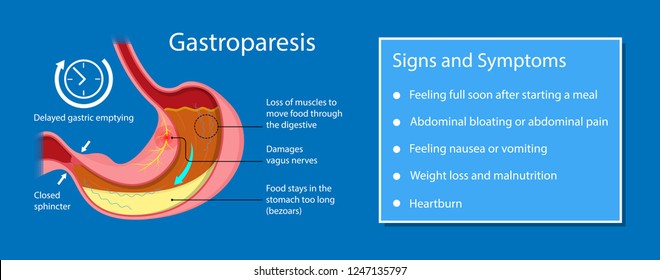 Gastroparesis stomach gastric emptying digestion disease infection Viral Amyloidosis scleroderma disorder gastroesophageal esophagus delayed delay surgery Multiple sclerosis Parkinson gastroenteritis