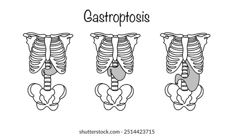 Gastroptose. Estágios do prolapso gástrico. Deslocamento do estômago para baixo além da linha de conexão das asas dos ossos ilíacos da pelve. Ilustração de vetor desenhada à mão.