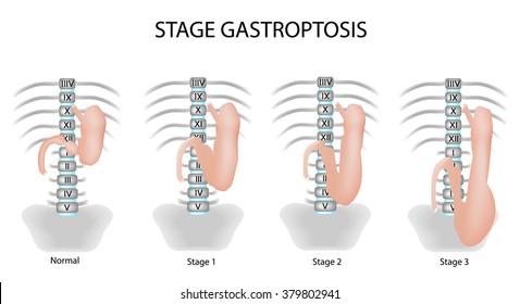 Gastroptosis stomach. The omission of the stomach. Stage gastroptosis. Vector illustration on isolated background.